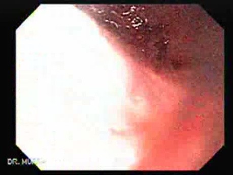 Esophagus - Pneumatic Dilation for Achalasia - Placement of the Balloon