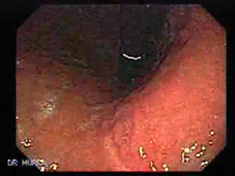 Hyperplastic Polyp - Endoscopy (5of 8)