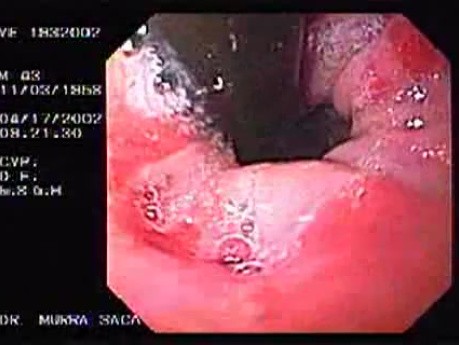 Barrett´s Esophagus (2 of 2)