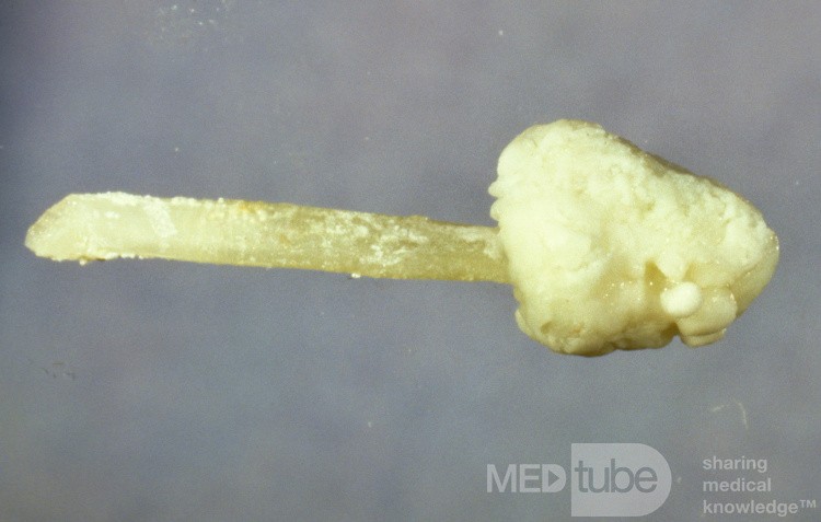 Calculus which is Developed on an Extruding Submandibular Gland Stent