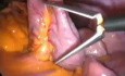 Laparoscopic excision of choledochal cyst type I