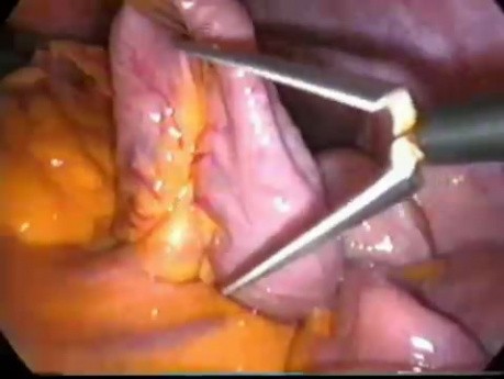 Laparoscopic excision of choledochal cyst type I