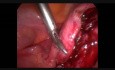 Laparoscopic Myomectomy