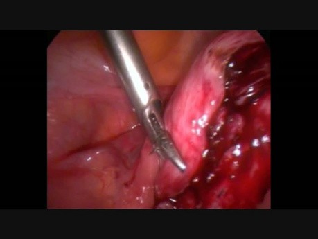 Laparoscopic Myomectomy