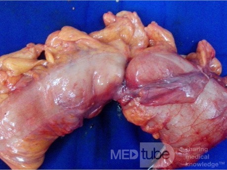 Cancer Sigmoid 