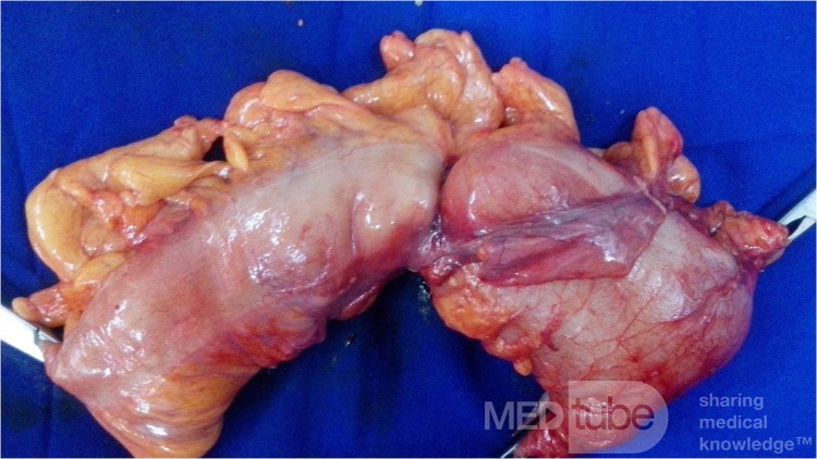 Cancer Sigmoid 