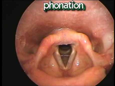 Laryngeal Movements and vocal folds positions