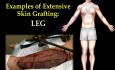 Extensive Skin Graft - Video Lecture - Part 2