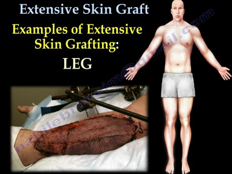 Extensive Skin Graft - Video Lecture - Part 2