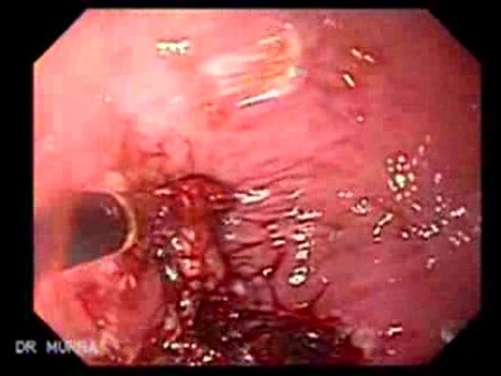 Debulking Of The Esophageal Tumor - Forceps - 2/2