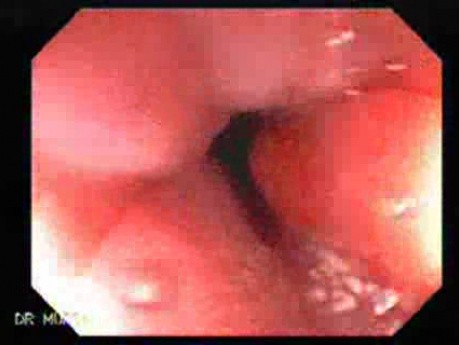 Multiple Adenomatous Polyps Of The Rectum (3 of 37)