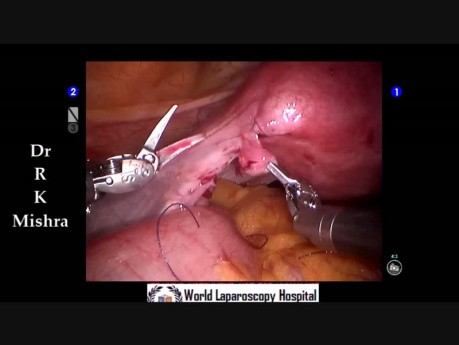 Robotic Tubal Recanalization Surgery