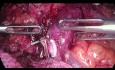 Laparoscopic Total Pancreatectomy for Pancreatic Head Tumor