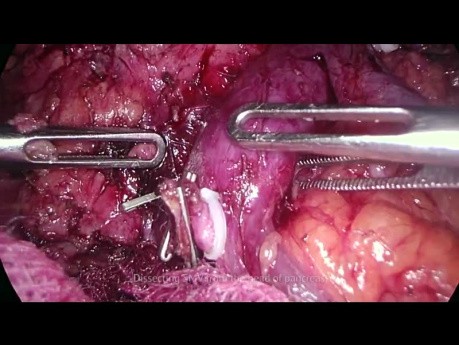 Laparoscopic Total Pancreatectomy for Pancreatic Head Tumor