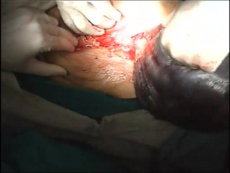 An Emergency Case - a Huge Benign Ovarian Cyst Torsion