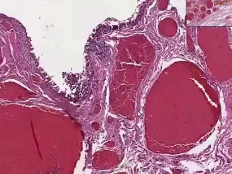 Hemorrhoids - Histopathology of anus 