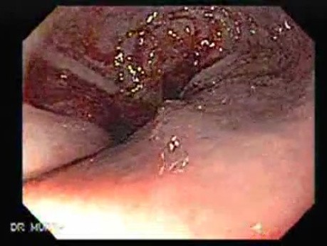 Adenocarcinoma of the Cardias - Beginning of the Procedure