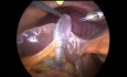 Laparoscopic Cholecystectomy with Accessory Cystic Duct  