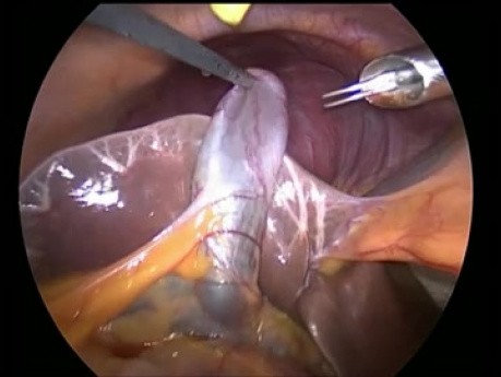 Laparoscopic Cholecystectomy with Accessory Cystic Duct  