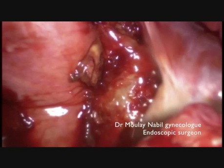 Laparoscopy for Ruptured Ovarian Corpus Luteum