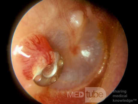Tube Granuloma