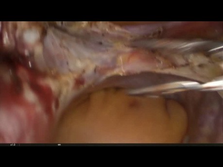 Subtotal Hysterectomy in case of Huge Uterus (1340 grammes)
