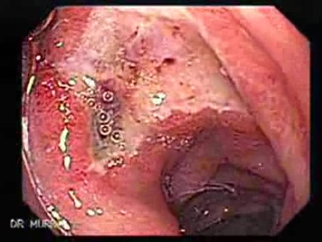 Duodenal Ulcer and Bleeding (12 of 23)
