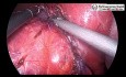 Laparoscopic Resection Myolipoma of Adrenal Gland