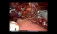 Robotic Pancreaticoduodenectomy with Antrectomy for Locally Advanced Duodenal Adenocarcinoma