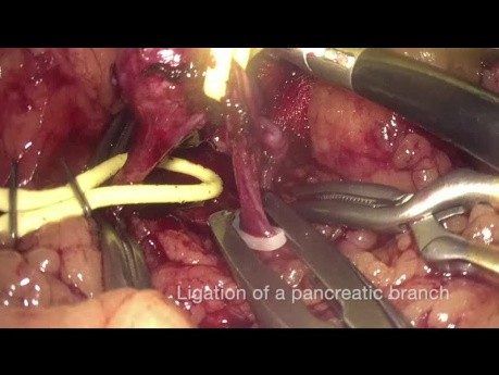 Laparoscopic Aneurismectomy with Direct Reconstruction of the Splenic Artery and Spleen Preservation