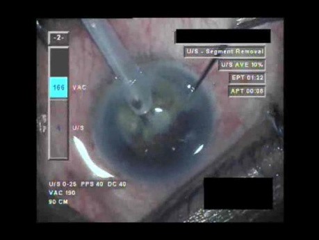 Cataract Surgery VIII - Part 2