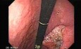 Endoscopy of small gastric cancer