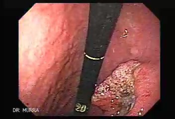 Endoscopy of small gastric cancer