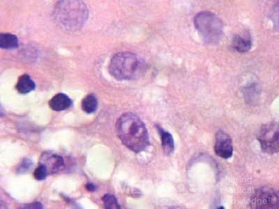 Cytomegalovirus Esophagitis (4 of 4)