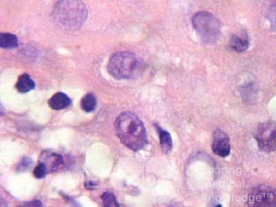 Cytomegalovirus Esophagitis (4 of 4)