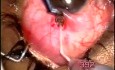 Tenon cyst formation and failure after earlier surgery. Singh filtration