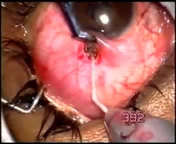 Tenon cyst formation and failure after earlier surgery. Singh filtration