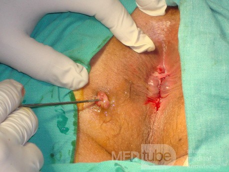 Fistula in Ano (5 of 7)