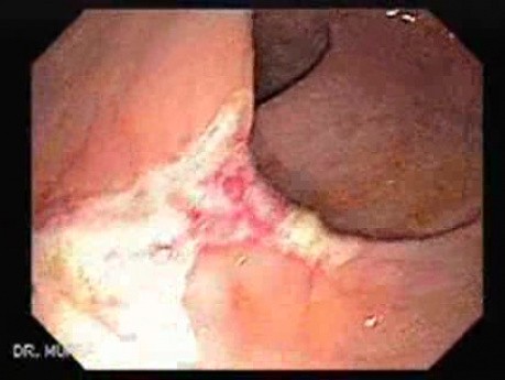 Histoplasmosis and Condyloma Accuminata (1 of 5)