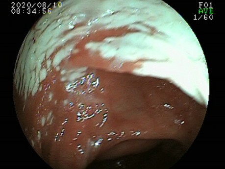 Colonoscopy Image Interpretation - Case
