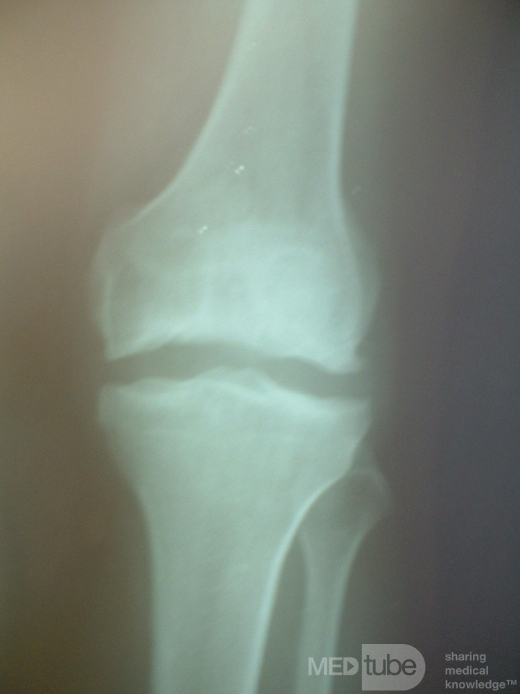 Fairbank Lesion