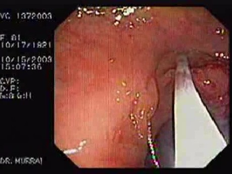 Tubulo - Villous Adenoma - Endoscopy (19 of 28)