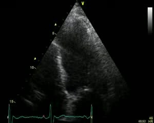 Ischemic Cardiomiopathy