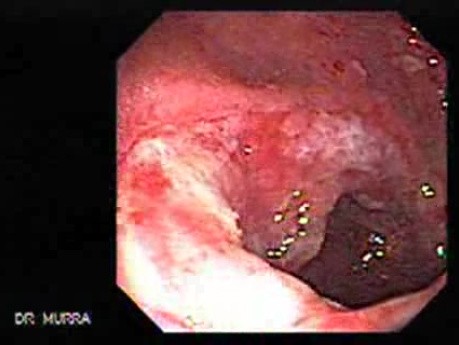 Multiple Adenomatous Polyps Of The Rectum (30 of 37)