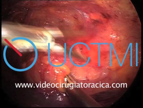 Anterior Mediastinal Mass Thoracoscopic Resection