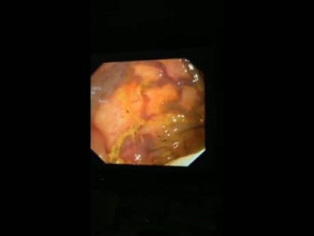 Isolated Colonic Varices on Hepatic Flexure