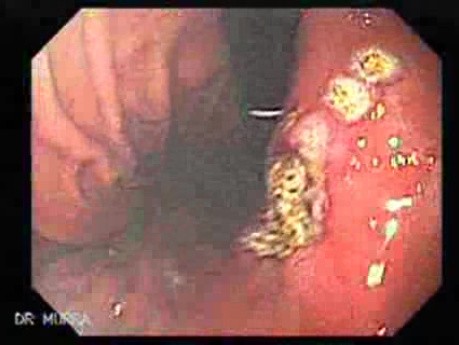 Hyperplastic Polyp - Endoscopy (8 of 8)
