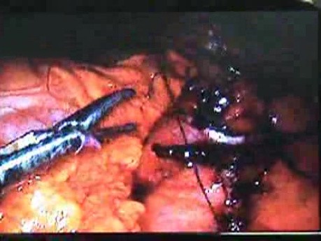 Jejunal Gastrointestinal Stromal tumor (GIST) (60 of 86)