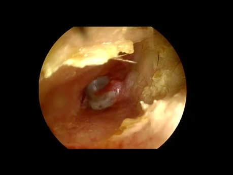 Infiltration of the Ear Canal - Endoscopic Ear Surgery