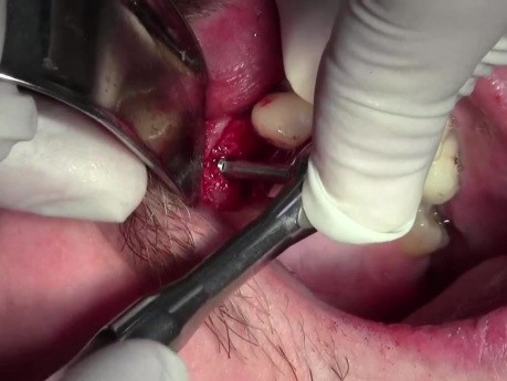 Implant Surgery #6 - Screwplant, Implant Direct, Mineross Regenerated Bone